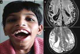 Image result for Drooling