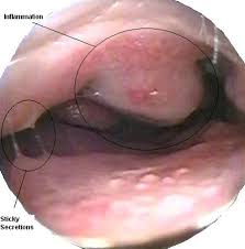 Image result for Allergic Rhinitis