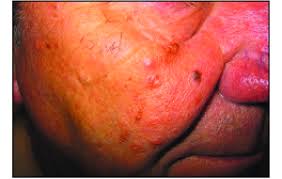 Sebaceous Adenomas On The Face In Muir Torre Syndrome Download Scientific Diagram
