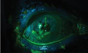 Keratitis is inflammation of the cornea, a clear and transparent covering over the iris and pupil.important forms of keratitis include bacterial, herpes zoster, herpes simplex, and acanthamoeba keratitis. A Primer On Herpes Simplex Keratitis
