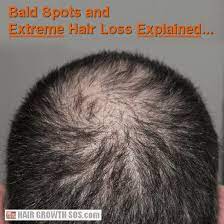 Why Bald Spots And Bald Patches Develop On The Back Of The Head Extreme Hair Dog Hair Loss Hair Loss Women