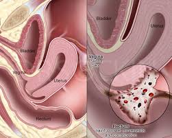 Endometriosis can be a challenging condition to manage. What Are The Symptoms Of Endometriosis Dr Seckin