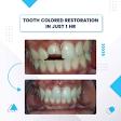 Dental Filling/Tooth Filling in Best Dental Clinic Dwarka product image