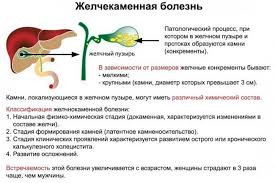 как избавиться от полипов в желчном пузыре народными методами Kak Vyvesti Kamni Iz Zhelchnogo Puzyrya Bez Operacii Narodnymi Metodami Zdorove Seldon Novosti
