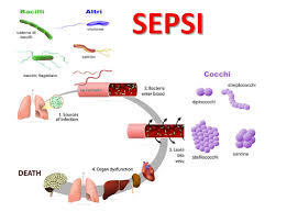Sepsis may progress to septic shock. Sepsi O Setticemia