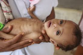They had been keeping their children, at the time aged two to 29, locked up, beaten and starved for police said the victims were so emaciated that they all looked like children, although seven of them. Hunger Stalks Children In Yemen As Un Cuts Aid Programs