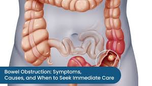 Image result for Intestinal Obstruction
