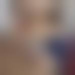 Image result for Proptosis