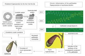 Concept Of The Pathogenesis And Treatment Of Cholelithiasis