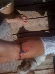 Motorcycle Leg Degloving Injury Motorcycle Degloving Injury