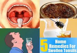 5 Home Remedies For Swollen Tonsils Remedies For Swollen Tonsils Swollen Tonsils Home Remedies