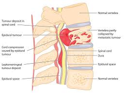 The bones of the pelvis and lower back work together to support the body's weight, anchor the abdominal and hip muscles, and protect the delicate vital organs of the vertebral and abdominopelvic cavities. Cancer And Spinal Fractures