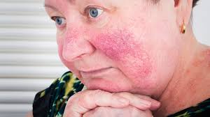Doch woher kommt rosacea und was kann. Rosazea Hautentzundung Im Gesicht Behandeln Ndr De Ratgeber Gesundheit