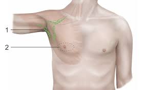 Image result for Mastectomy