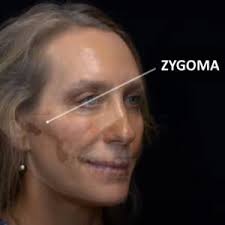 Tutorial: injection points for cheek filler