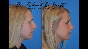 Rhinoplasty with Dr. Richard Parfitt (Day of Surgery)