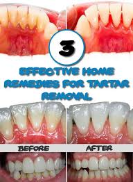 3 Effective Home Remedies For Tartar Removal Natural Health Tips Health And Beauty Tips Home Remedies