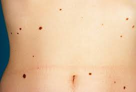 Black people can get skin cancer, though it is less likely to affect them than people with lighter skin. Skin Cancer Symptoms Types Images