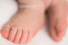 Peeling skin on hands affects millions of people in the world. Newborn Skin Peeling Causes Treatment