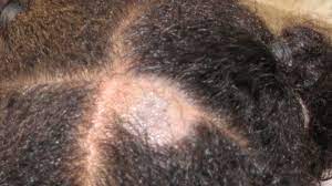 Your scalp is also regularly exposed to environmental irritants, such as pollution. Scalp Conditions Pictures Causes And Treatments
