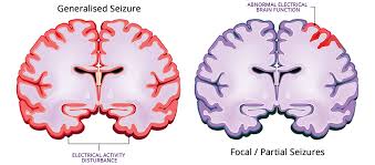 Image result for Absence Seizure