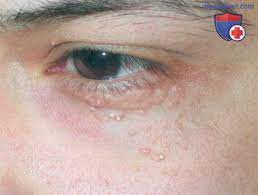 Сальные железы развиваются из эпителия волосяных фолликулов и в большинстве случаев открываются в. Giperplaziya Salnyh Zhelez Diagnostika I Lechenie