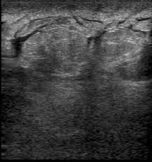 But breast redness is a classic symptom of inflammatory breast cancer. Inflammatory Carcinoma Breast Radiology Case Radiopaedia Org