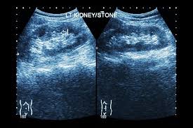 Kidney Stone Risk Higher In Patients With Ankylosing Spondylitis Study Kidney Stones Rheumatoid Arthritis Renal Calculi