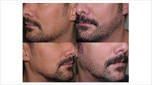 But is it worth it? Beard Transplants Westminister Clinic