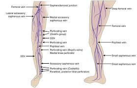 Image result for Perthes Test