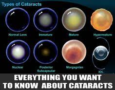 Don't get stuck asking, how do you know if you have cataracts or not? find out once and for all with the help of our team of cataract experts! 25 Cataracts Ideas In 2021 Cataract Eye Health Cataract Surgery