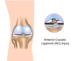 This video explains what is acl and how to. Acl Anterior Cruciate Ligament Torn Acl Injury Repair