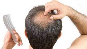 Waktu melihat rambut rontok tersebut, gw jadi teringat salah satu teman gw dulu yang punya masalah dengan rambutnya yang rontok terus. Kebiasaan Buruk Penyebab Rambut Rontok Yang Sering Disepelekan Jarang Keramas Halaman All Tribun Solo