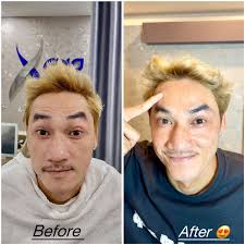 បងបងកុំទុកស្នាមជ្រួយលើផ្ទៃមុខធ្វើអ្វីឆាប់មកហ្សុីណូគ្លីនិចមកធានាត្រឹមរយះពេលខ្លីគឺ  ស្អាត ក្មេងជាងវ័យ 👉ស្អាត សុវត្តិភាព តំលៃពិសេស ...