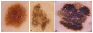 Image result for Dermoscopy