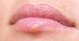 Herpes kan gi smertefulle sår på munnen. Dette Trigger Herpes Og Forkjolelsessar Helse