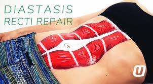 How do you know if you have diastasis recti. What Is Diastasis Recti And How Do You Repair It Moveu