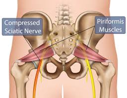 The piriformis muscle is important for lower body movement because it stabilizes the hip joint. Sciatica Symptoms Diagnosis Treatment Miami Neuroscience Center