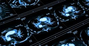 Subţierea peretelui cerebral este principala cauză a anevrismului, existând şi câţiva factori de risc: Anevrism 4 Lucruri Pe Care Trebuie Sa Le Stii Neuroaxis