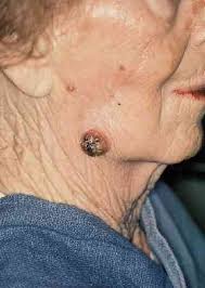 Image result for Merkel Cell Carcinoma