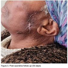 Image result for cornu cutaneum)