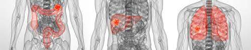 The exact reason of metastatic colon cancer cells is not known. Metastatic Bowel Cancer Bowel Cancer Australia