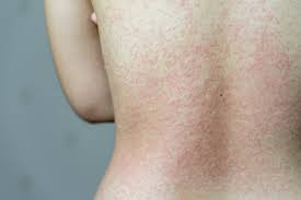 Persistent, prolonged high fever (4 days or more) lethargy skin rash or discoloration (pale, patchy or blue skin) red eyes, lips and tongue swollen hands and feet no appetite, difficulty feeding in. Skin Symptoms Of Covid 19 What To Look Out For Ri Skin Doc