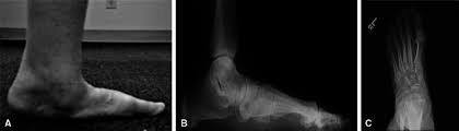 Classifications In Brief Johnson And Strom Classification Of Adult Acquired Flatfoot Deformity Abstract Europe Pmc