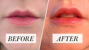 Find lip balm coupons, promotions and product reviews on walgreens.com. I Tried Restylane Kysse For Fuller Yet Natural Looking Lips Review Allure