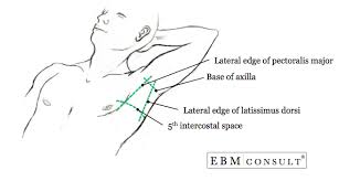 Chest Tube Placement Thoracostomy Procedure