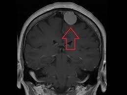 Even though it may happen due to a. Cervical Cancer Symptoms Causes Stages And Treatment