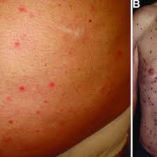 Does hsv2 first outbreak may look like a normal rash, or ulcers (or blisters, or papules) are seen from the begining of the outbreak itching starts? answered by dr. Maculopapular Distribution Of Herpes Lesions In Right Buttock A And Download Scientific Diagram