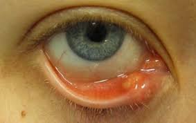 Pimple Or Bump Inside Eyelid Agespotstreatments Pimple On Eyelid Stye Treatment Pimples