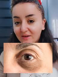 Göz Altı Qara Dairələrin Səbəbləri